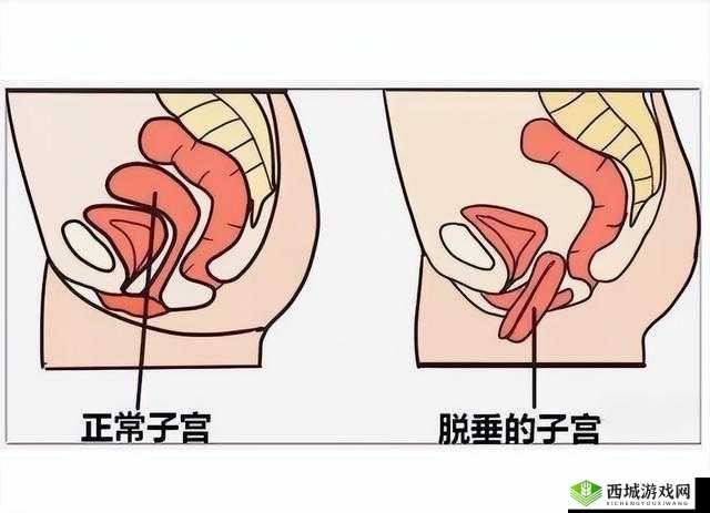 女性阴挺病:其发病原因究竟为何